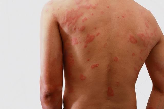 Julgamento sobre prescrição em indenizações a filhos separados por hanseníase é interrompido por pedido de vista